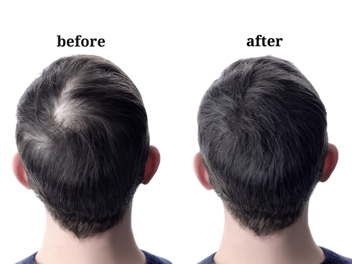 hair growth