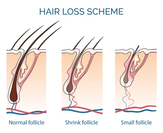 hair regrowth